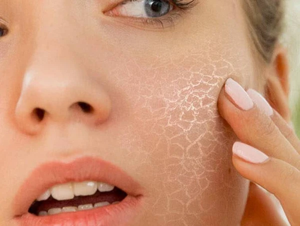 How Dehydration Affects Your Face