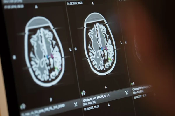 A Marker of Accelerated Brain Aging Identified