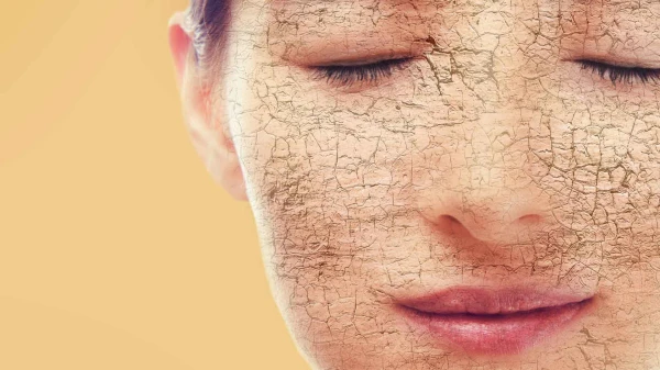 In the Dry Residue: How to Deal with Skin Peeling in Cold Weather