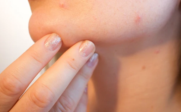 Face Map: What Pimples May Mean