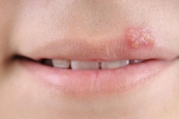 Non-healing Herpes: A Doctor Explains Its Dangers