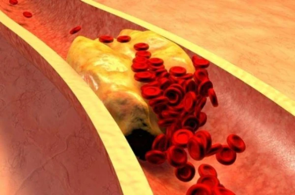 How to Avoid Thrombosis: 3 Drinks and 3 Foods That Promote Blood Clotting