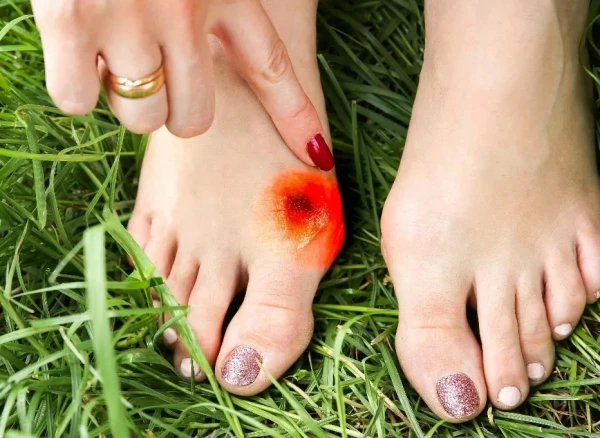 Bump on the Foot: Is Surgery Worth It Just for Beauty?