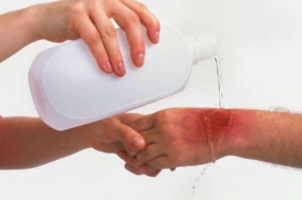 How to Provide First Aid for Burns at Home?