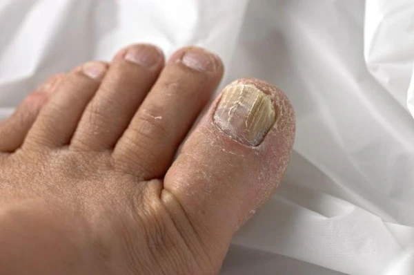 Can you get rid of skin and nail fungus with henna?