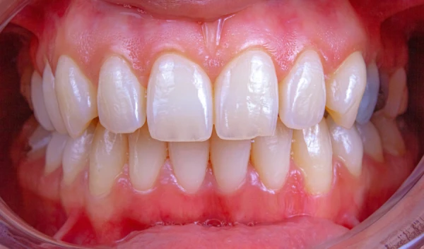 A woman was almost completely deprived of her teeth at a clinic in Turkey