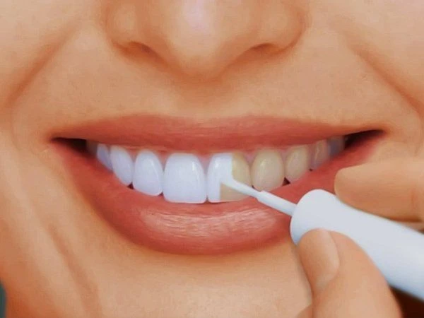 Home Teeth Whitening: Benefits, Risks, and Dentists' Opinions