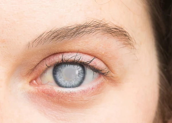 Early Signs of Glaucoma: How Not to Miss a Dangerous Disease