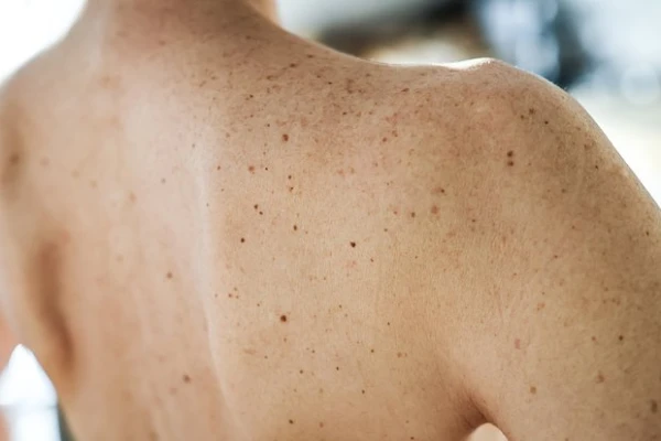 Scientist Names Unobvious Symptom of Cancer