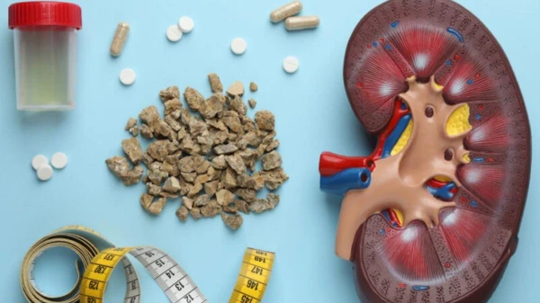 Kidney Stones: Doctors Named Provocative and Protective Foods