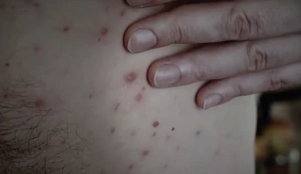 Outbreak of a Dangerous Disease in Ilguciems, Riga