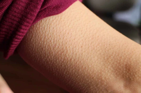 Goosebumps Don't Go Away: When It's Normal and When It's Time to Take Care