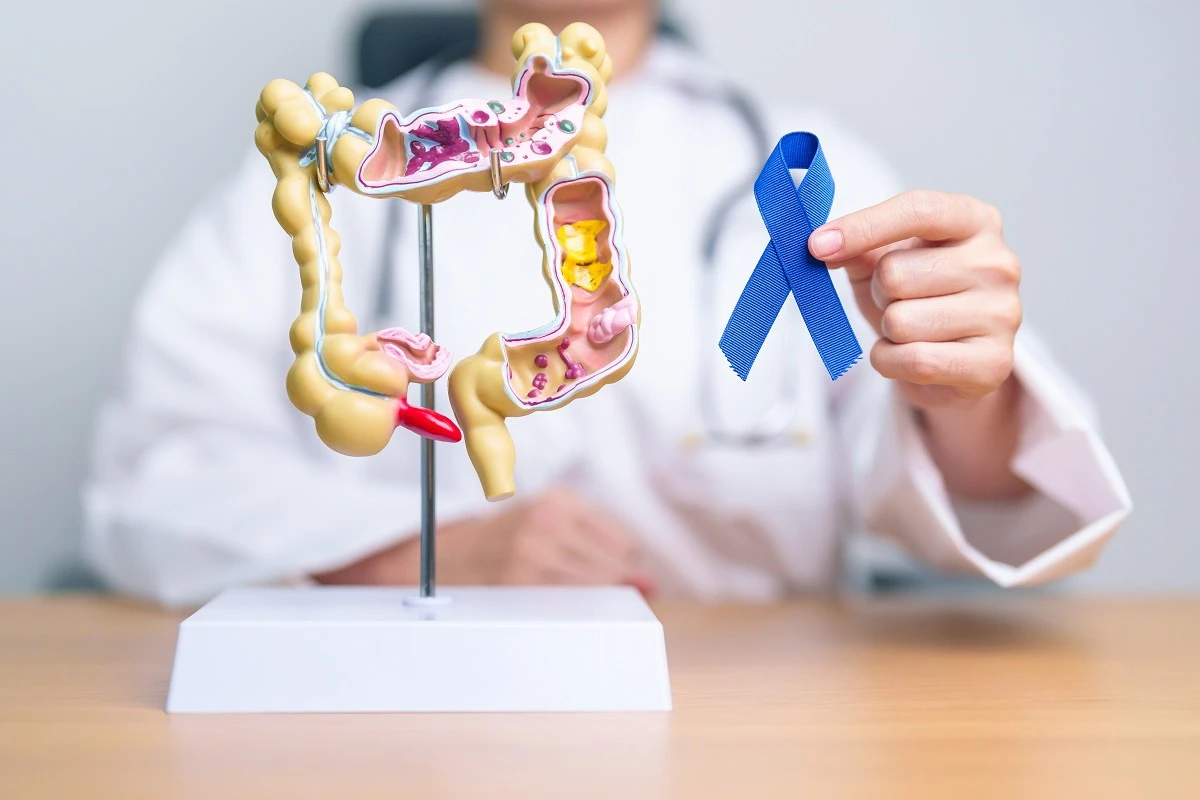 Scientists Warn of Rising Colorectal Cancer in Young People